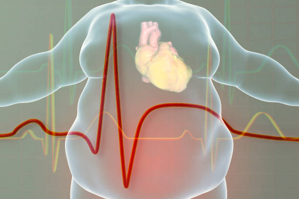 los ataques al corazón son propensos en personas obesas si engordan después de reducción de estómago