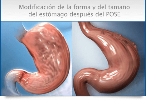 antes y después de operación de reducción de estómago método pose