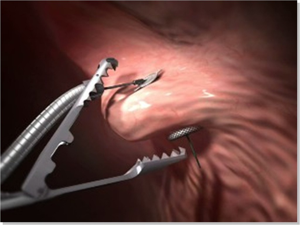 ilustración 3D operación de reducción de estómago