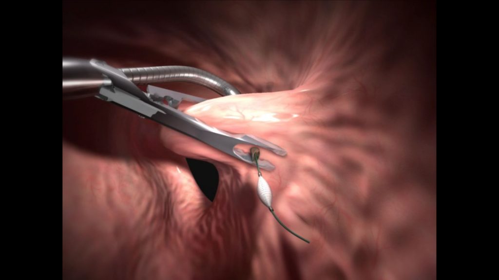 otra ilustración 3D de una operación de reducción de estómago