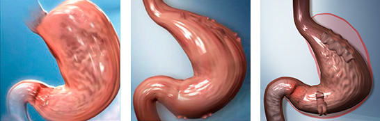 operación reducción de estómago ilustraciones 3D