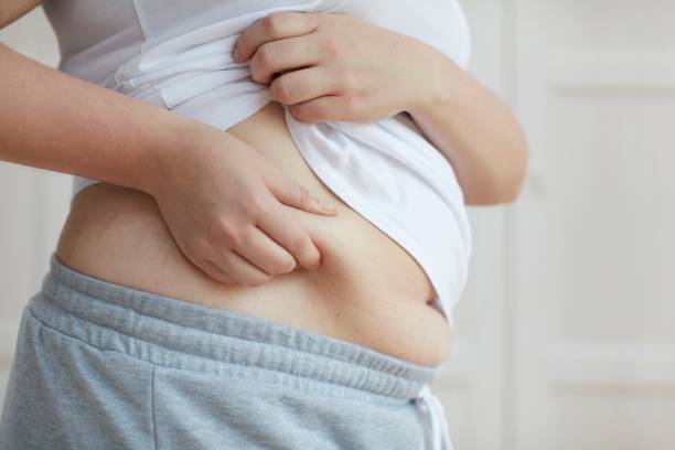 recaída en la obesidad reducción de estómago efectos secundarios