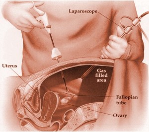 reducción de estómago por laparoscopia ilustración