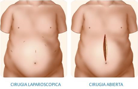 comparación reducción de estómago por laparoscopia