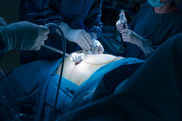 laparoscopia operación reducción de estómago