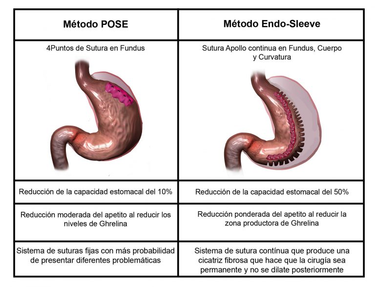 Reducción de estómago sin cirugía ¡Técnicas y tendencias! 【2019】
